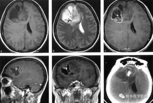ct对人体的伤害有多大,ct x光区别