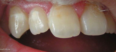 牙齿钙化是怎么回事