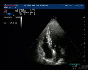 血流变是什么检查项目,血流变是什么意思