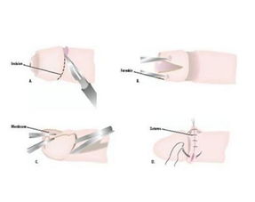环切术脱落过程